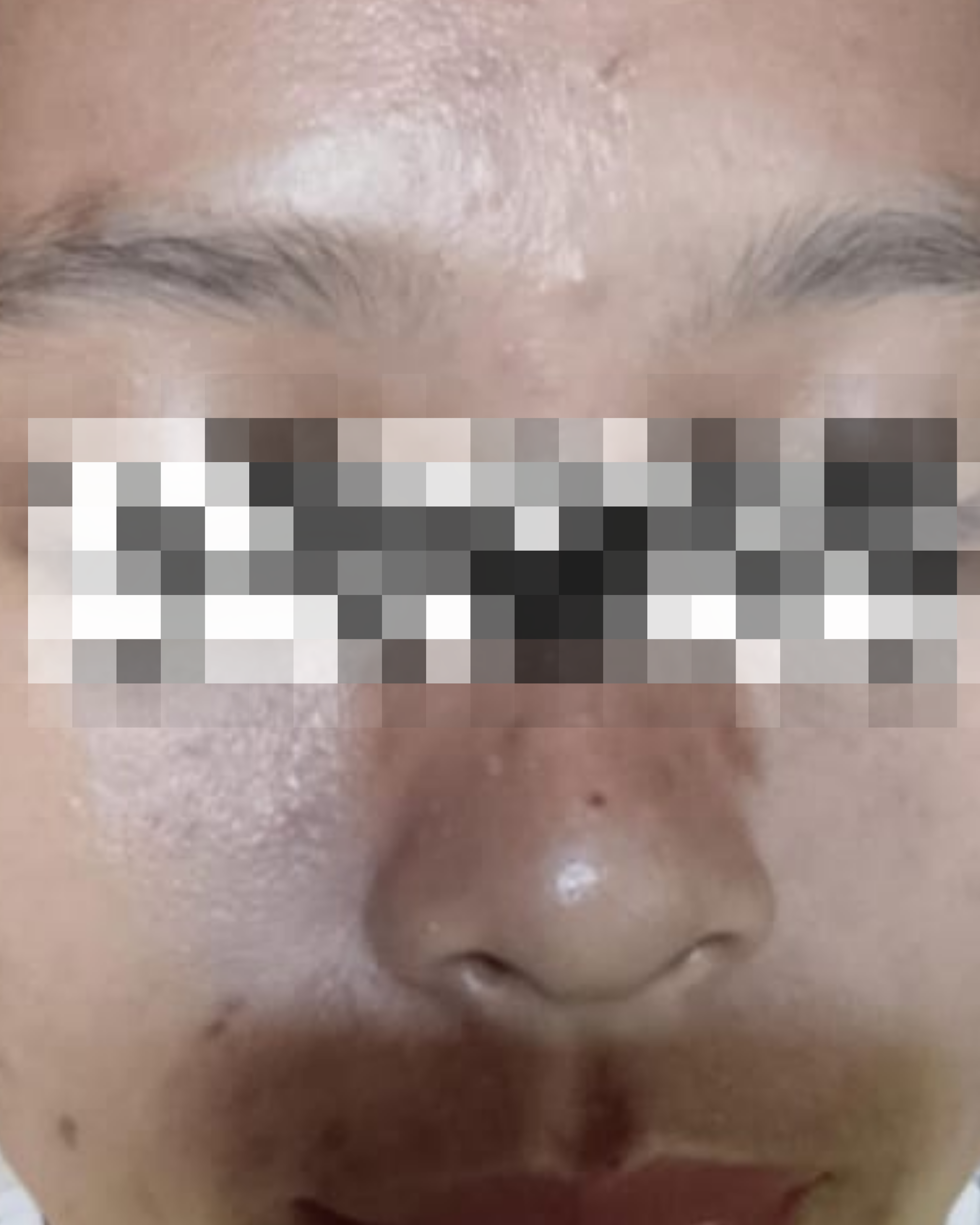 After Treatment
