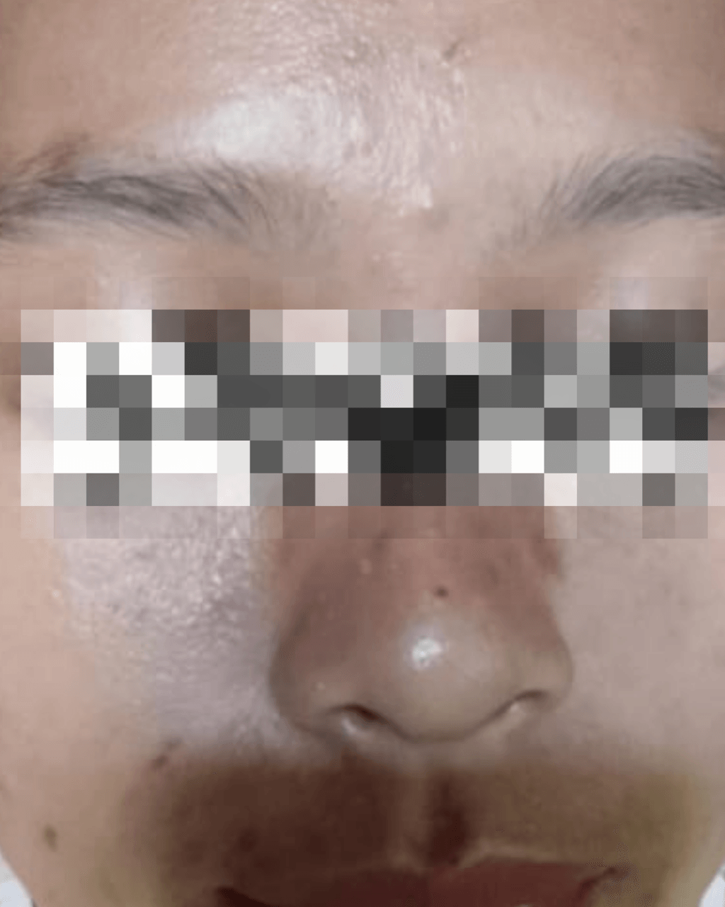 Sesudah Acne Treatment
