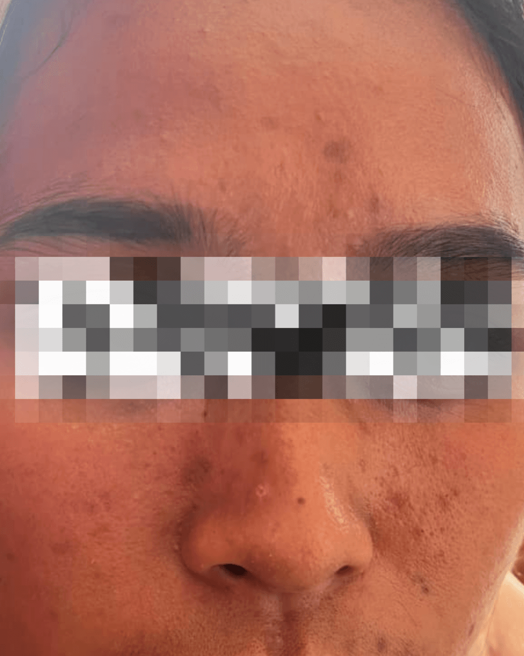 Sebelum Acne Treatment